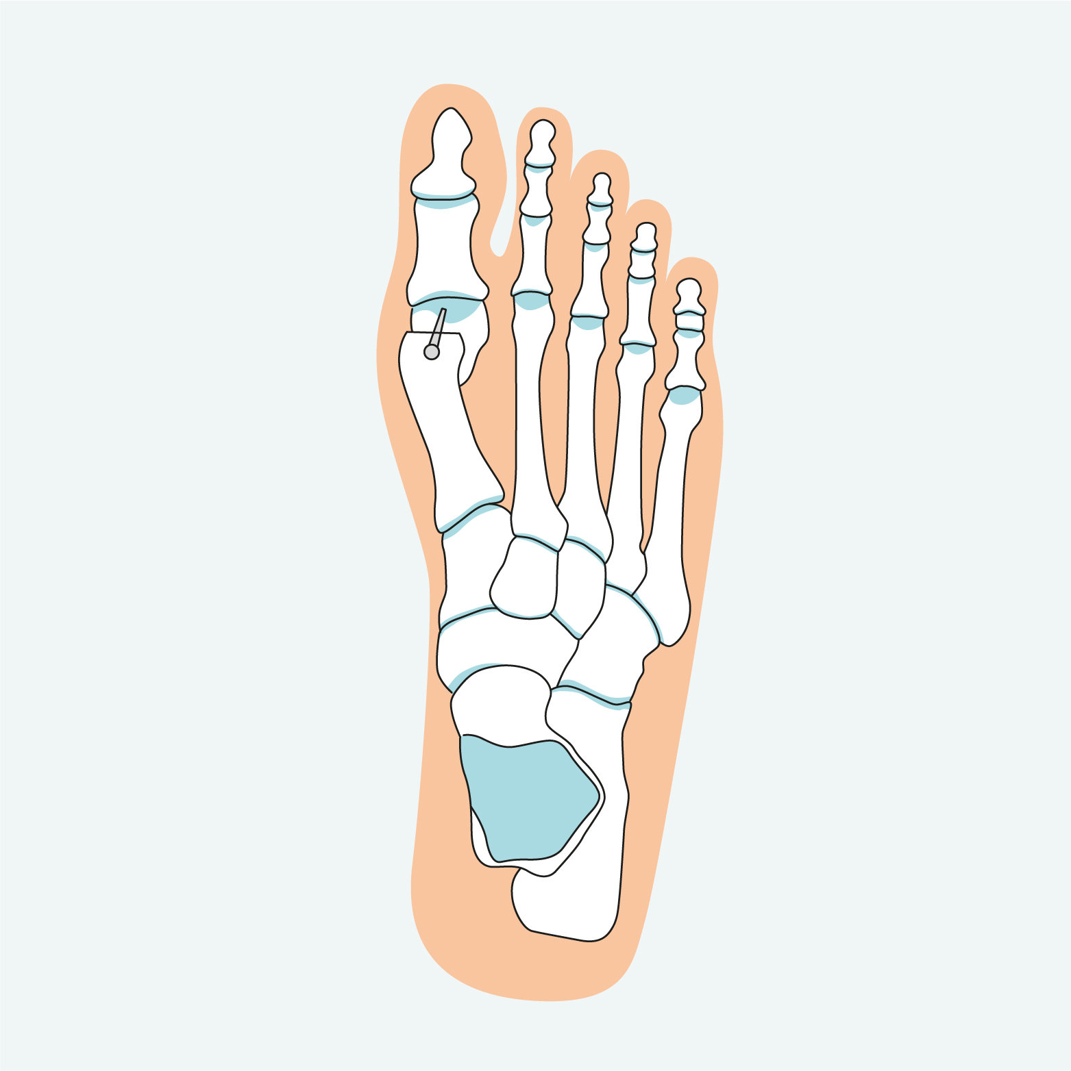 1.25A Standscorrectie Grote Teen Chevron Osteotomie